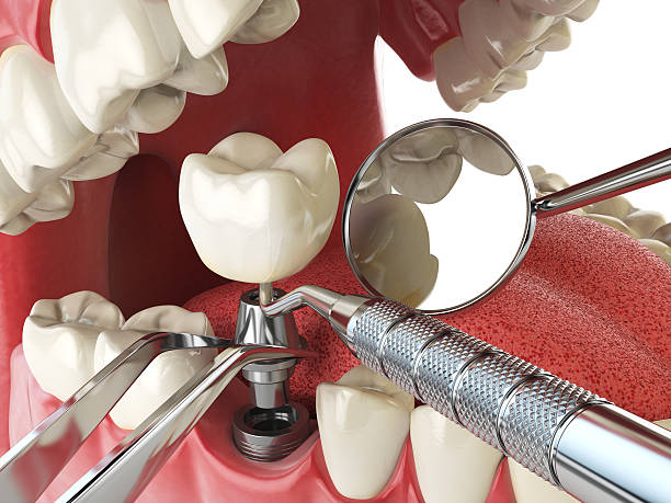 Best Emergency Wisdom Tooth Extraction in USA